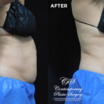 patient before and after results with CoolSculpting at Contemporary Plastic Surgery