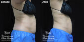 patient before and after results with CoolSculpting at Contemporary Plastic Surgery