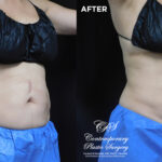 patient before and after results with CoolSculpting at Contemporary Plastic Surgery