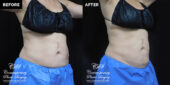 patient before and after results with CoolSculpting at Contemporary Plastic Surgery