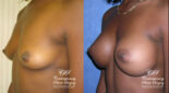 breast augmentation