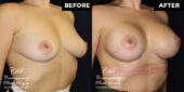 breast augmentation
