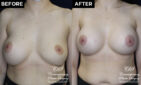 breast implant replacement at Contemporary Plastic Surgery