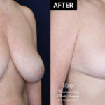 breast reduction before and after patient results at Contemporary Plastic Surgery
