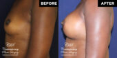 breast augmentation