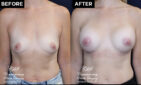 breast augmentation patient results at Contemporary Plastic Surgery