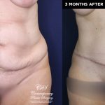 tummy tuck before and after results at Contemporary Plastic Surgery