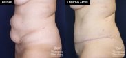 tummy tuck before and after results at Contemporary Plastic Surgery