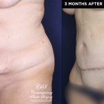 tummy tuck before and after results at Contemporary Plastic Surgery