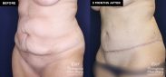 tummy tuck before and after results at Contemporary Plastic Surgery