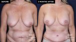 breast augmentation before and after results at Contemporary Plastic Surgery