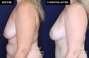 breast augmentation before and after results at Contemporary Plastic Surgery
