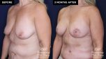 breast augmentation before and after results at Contemporary Plastic Surgery