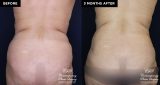 tummy tuck before and after results at Contemporary Plastic Surgery