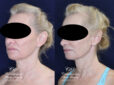 posterior neck lift