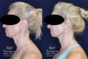 posterior neck lift