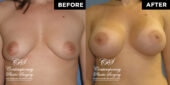 Patient had a high profile, round, smooth, responsive gel 400 cc implant placed under the pectoralis muscle on both sides through incisions under the breast #12899 3 months postop pics | Patient #12899’s Breast Augmentation at Jacksonville plastic surgery clinic, Contemporary Plastic Surgery