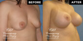 Patient had a high profile, round, smooth, responsive gel 400 cc implant placed under the pectoralis muscle on both sides through incisions under the breast #12899 3 months postop pics | Patient #12899’s Breast Augmentation at Jacksonville plastic surgery clinic, Contemporary Plastic Surgery