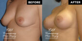 Patient had a high profile, round, smooth, responsive gel 400 cc implant placed under the pectoralis muscle on both sides through incisions under the breast #12899 3 months postop pics | Patient #12899’s Breast Augmentation at Jacksonville plastic surgery clinic, Contemporary Plastic Surgery