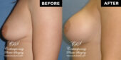 Patient had a high profile, round, smooth, responsive gel 400 cc implant placed under the pectoralis muscle on both sides through incisions under the breast #12899 3 months postop pics | Patient #12899’s Breast Augmentation at Jacksonville plastic surgery clinic, Contemporary Plastic Surgery