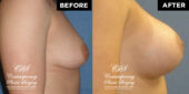 Patient had a high profile, round, smooth, responsive gel 400 cc implant placed under the pectoralis muscle on both sides through incisions under the breast #12899 3 months postop pics | Patient #12899’s Breast Augmentation at Jacksonville plastic surgery clinic, Contemporary Plastic Surgery
