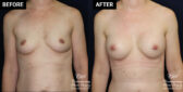 breast augmentation patient results at Contemporary Plastic Surgery