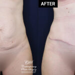 abdominoplasty tummy tuck patient results at Contemporary Plastic Surgery
