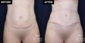 abdominoplasty tummy tuck patient results at Contemporary Plastic Surgery