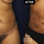 liposuction patient before and after results at Contemporary Plastic Surgery