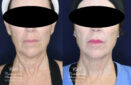 posterior neck lift