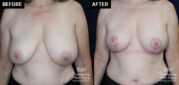 breast lift patient results at Contemporary Plastic Surgery