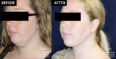 chin liposuction patient results at Contemporary Plastic Surgery