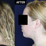 chin liposuction patient results at Contemporary Plastic Surgery
