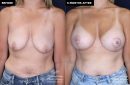 patient 15361's breast lift and implant surgery at Contemporary Plastic Surgery