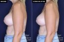 patient 15361's breast lift and implant surgery at Contemporary Plastic Surgery