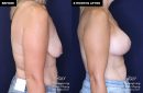 patient 15361's breast lift and implant surgery at Contemporary Plastic Surgery