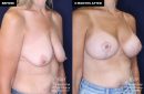 patient 15361's breast lift and implant surgery at Contemporary Plastic Surgery