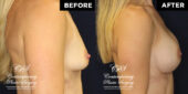 Patient desired improvement in breast volume, projection & firmness.  She had a round, smooth, highly cohesive silicone gel-filled implant of 255 cc volume placed underneath pectoralis muscles on both sides. | Patient #15507’s Breast Augmentation at Jacksonville plastic surgery clinic, Contemporary Plastic Surgery