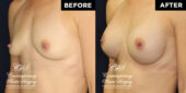 Patient desired improvement in breast volume, projection & firmness.  She had a round, smooth, highly cohesive silicone gel-filled implant of 255 cc volume placed underneath pectoralis muscles on both sides. | Patient #15507’s Breast Augmentation at Jacksonville plastic surgery clinic, Contemporary Plastic Surgery