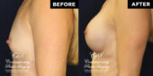 Patient desired improvement in breast volume, projection & firmness.  She had a round, smooth, highly cohesive silicone gel-filled implant of 255 cc volume placed underneath pectoralis muscles on both sides. | Patient #15507’s Breast Augmentation at Jacksonville plastic surgery clinic, Contemporary Plastic Surgery