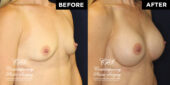 Patient desired improvement in breast volume, projection & firmness.  She had a round, smooth, highly cohesive silicone gel-filled implant of 255 cc volume placed underneath pectoralis muscles on both sides. | Patient #15507’s Breast Augmentation at Jacksonville plastic surgery clinic, Contemporary Plastic Surgery