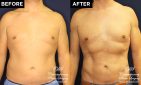 body contouring before and after patient results at Contemporary Plastic Surgery