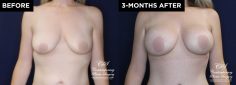 patient 15895 breast augmentation results at Contemporary Plastic Surgery