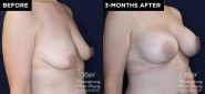 patient 15895 breast augmentation results at Contemporary Plastic Surgery