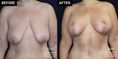 breast lift and breast augmentation patient results at Contemporary Plastic Surgery