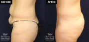 tummy tuck patient before and after results at Contemporary Plastic Surgery
