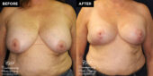 breast reduction surgery