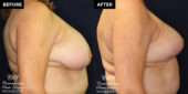 breast reduction surgery