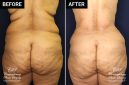 tummy tuck and liposuction patient results at Contemporary Plastic Surgery