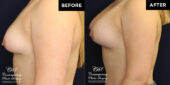 breast augmentation